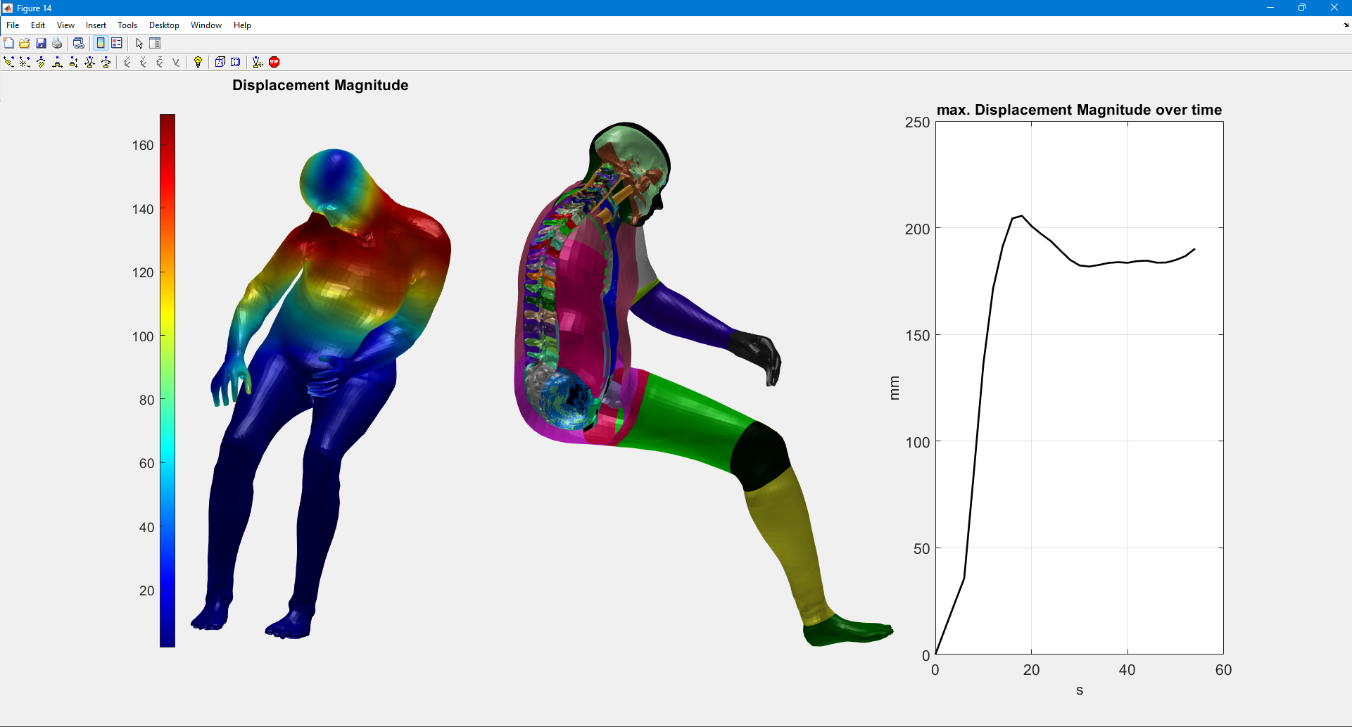 deformation analysis of a human body model (vivaplus, viva+, openradioss)